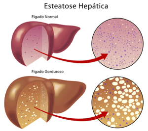 Esteatose hepática Dr. Vinícius Pelloso